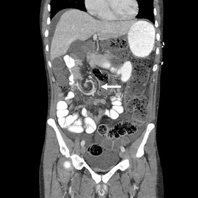 Cecal Volvulus as a Rare Complication of Osimertinib Dosed at 160 mg in Patients With EGFR-Mutant Non-small Cell Lung Cancer